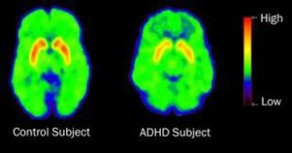 Brain scan of differences of adult with ADHD and without