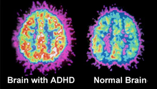 adhd brain scan